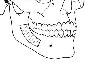 greffe-osseuse-prelevement-angle-mandibulaire-chirurgie-pre-implantaire-docteur-bontemps
