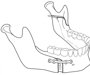 osteotomie-sagittale-de-la-branche-montante-mandibulaire-3-chirurgie-orthognatique-docteur-bontemps